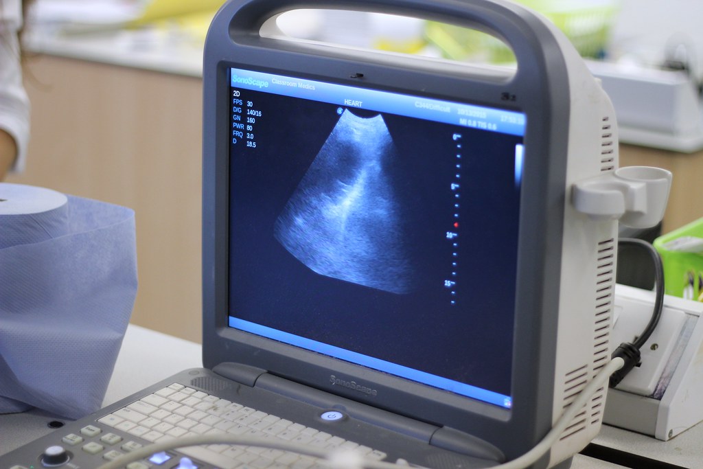 Sonography machine showing a scan